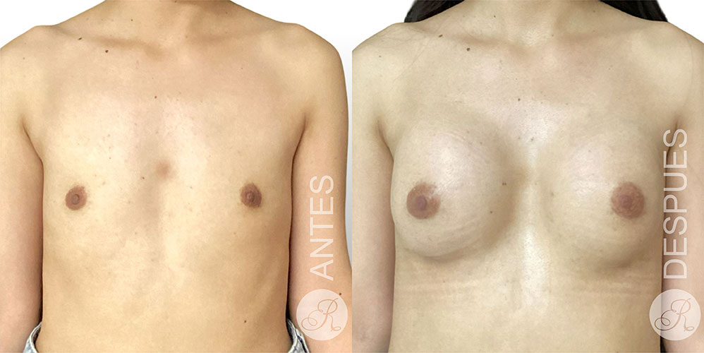 Mamoplastia de aumento Clinica Renacer