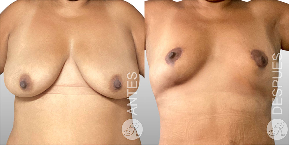 Mamoplastia de suspension Clinica Renacer