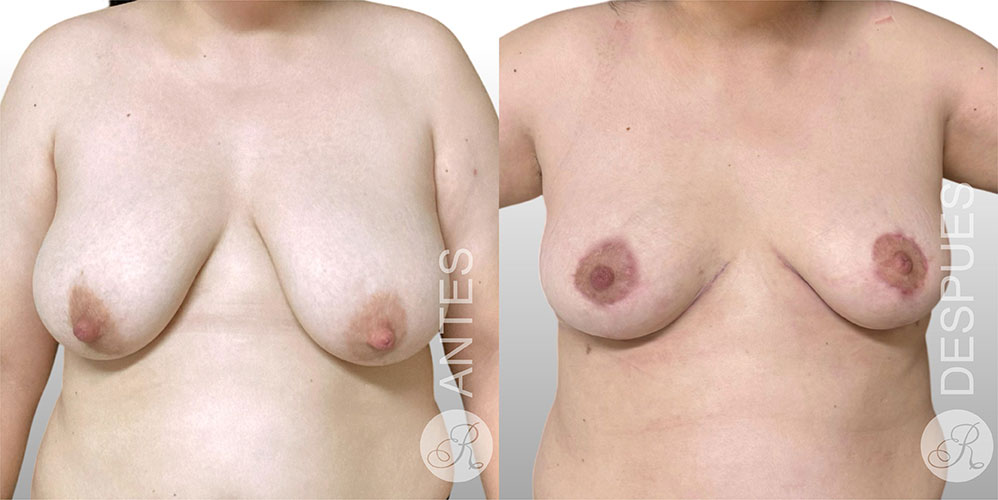 Mamoplastia de suspension Clinica Renacer