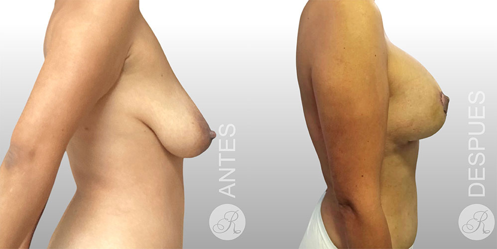 Mamoplastia de suspension Clinica Renacer