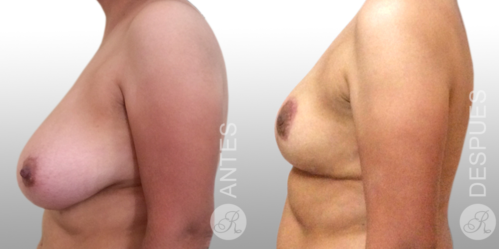 Mamoplastia de aumento Clinica Renacer