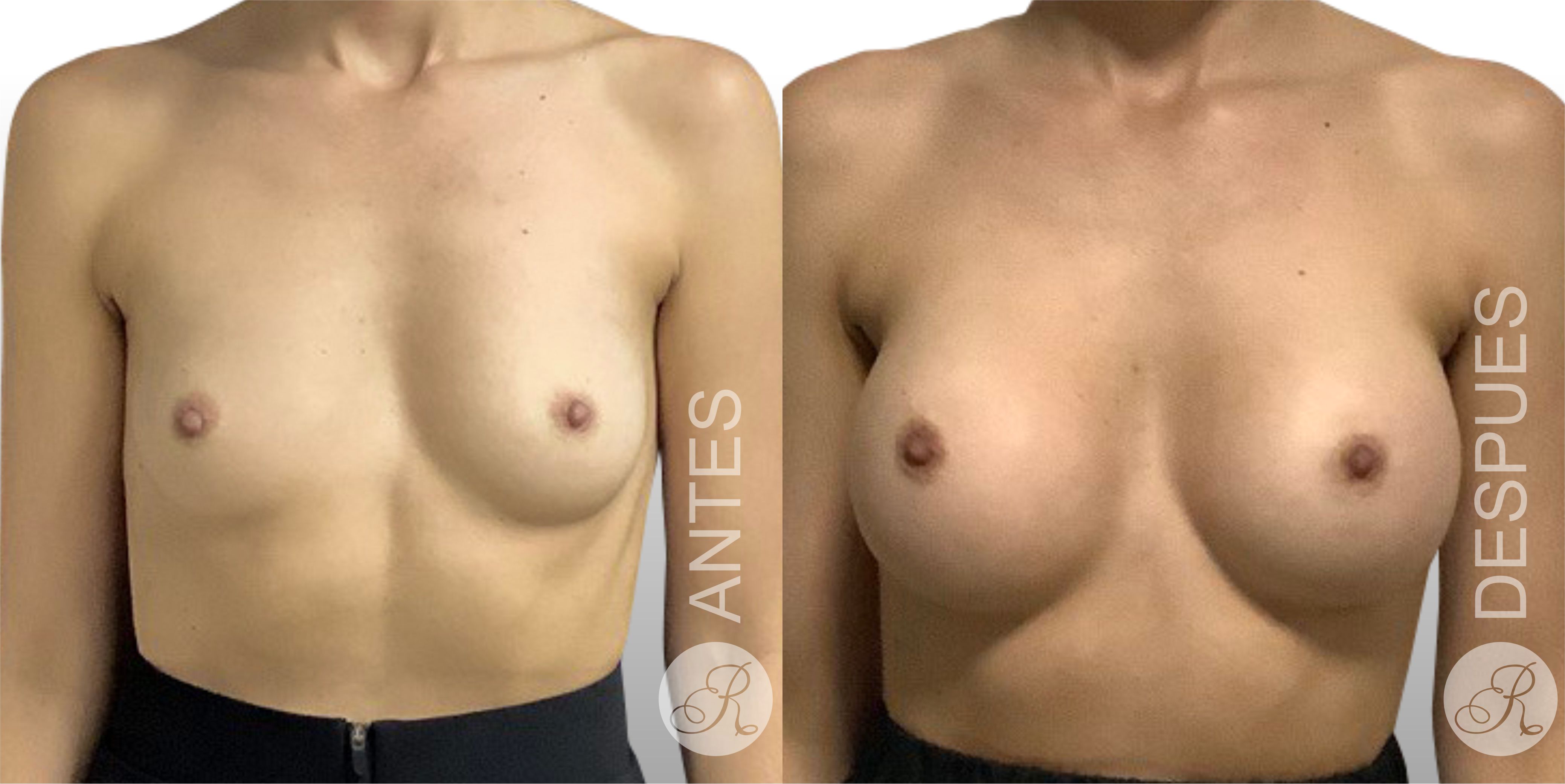 Mamoplastia de aumento Clinica Renacer