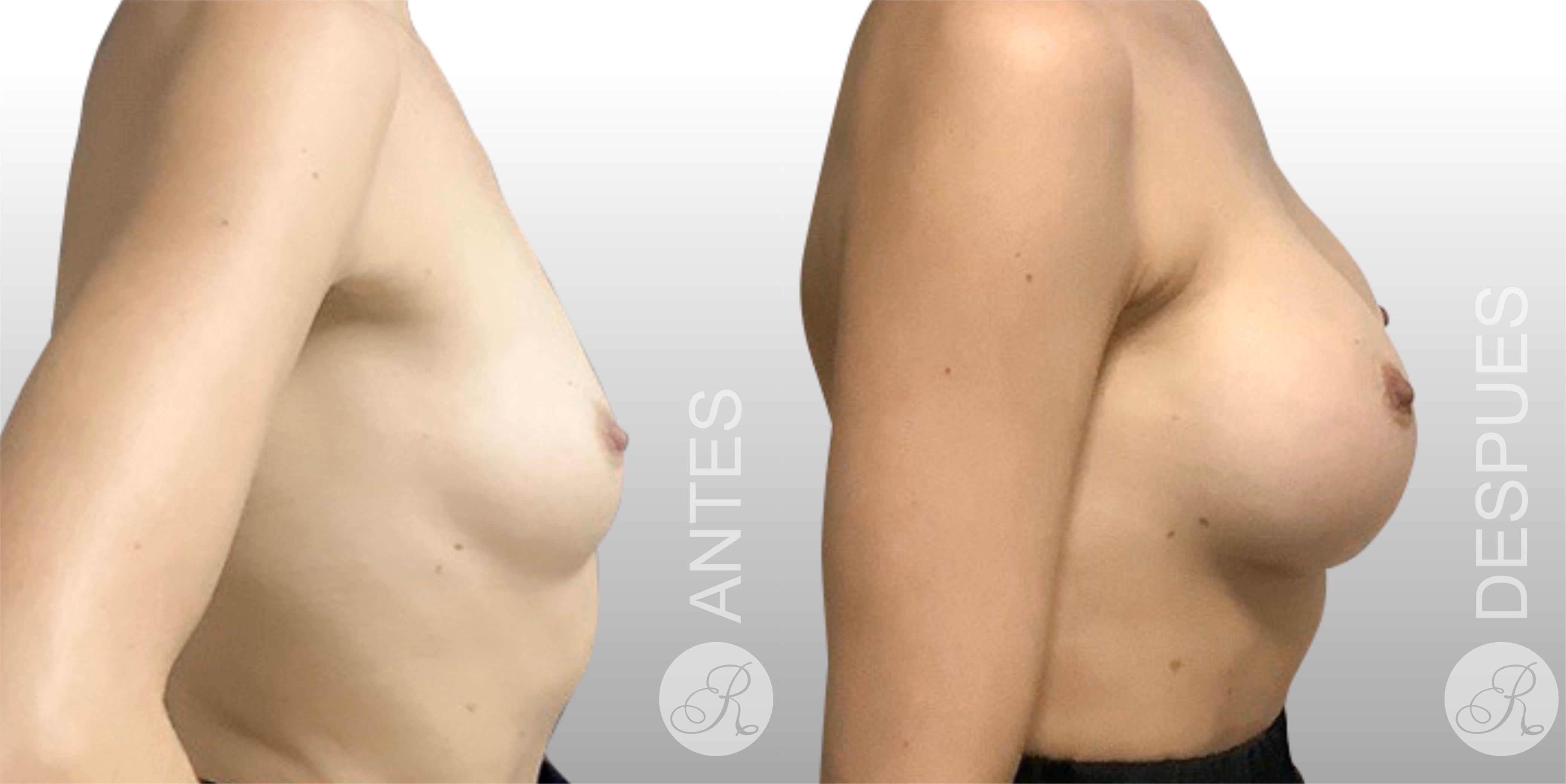 Mamoplastia de aumento Clinica Renacer