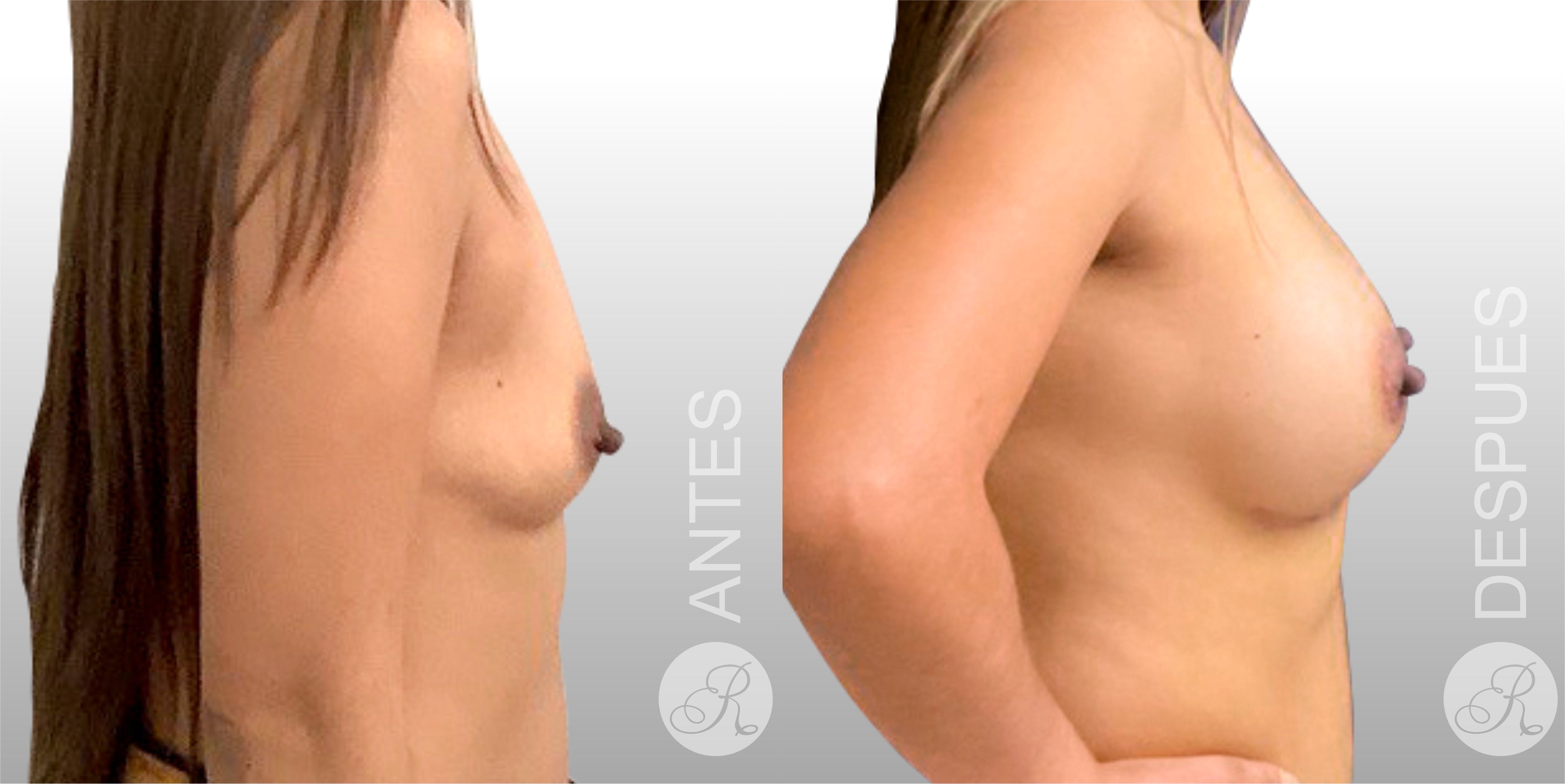 Mamoplastia de aumento Clinica Renacer