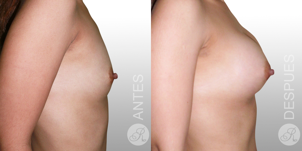 Mamoplastia de aumento Clinica Renacer