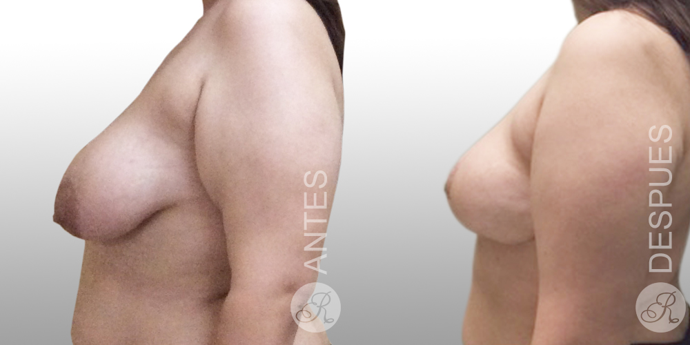 Mamoplastia de aumento Clinica Renacer
