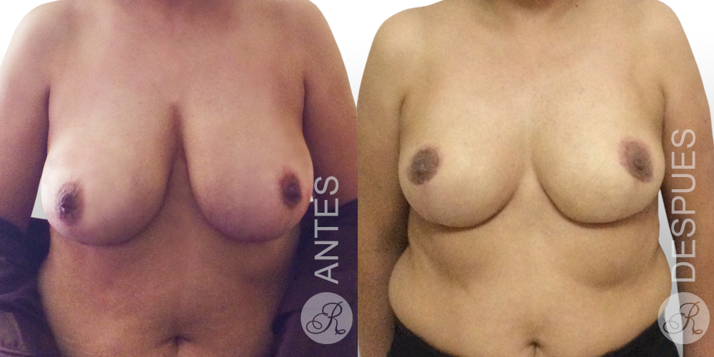 Mamoplastia de aumento Clinica Renacer